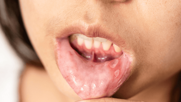 Atsirado opų ar žaizdelių burnos ertmėje? Priežastys ir gydymo būdai