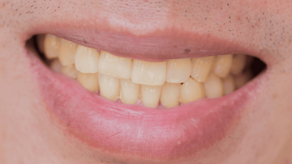 Dantų erozija: šios ligos priežastys ir gydymo būdai