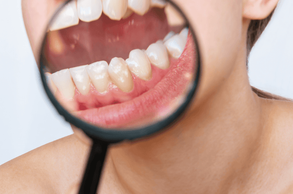 Dantų fluorozė: kas tai, atsiradimo priežastys ir gydymo metodai