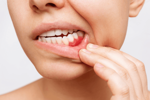 Kodėl kraujuoja jūsų dantenos ir ką tai pasako