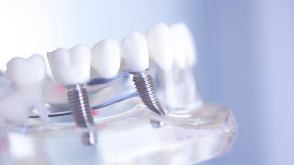 Kokias burnos priežiūros priemones rinktis turint implantų