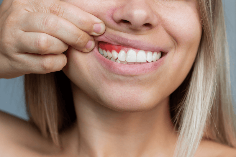 6 patarimai, kaip sustabdyti dantenų kraujavimą